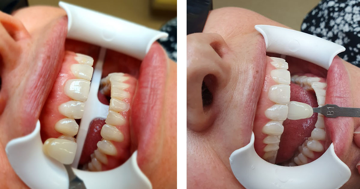 Hampaiden valkaisu, ennen ja jälkeen kuva